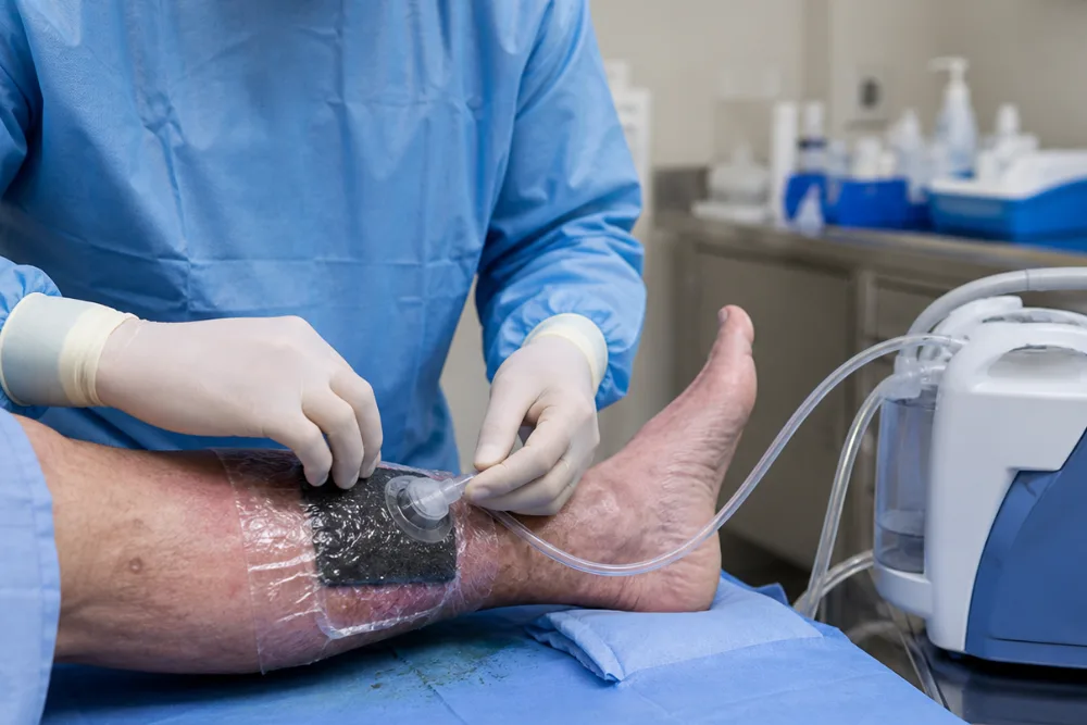 Manejo avanzado de heridas con la terapia de presión negativa (VAC)